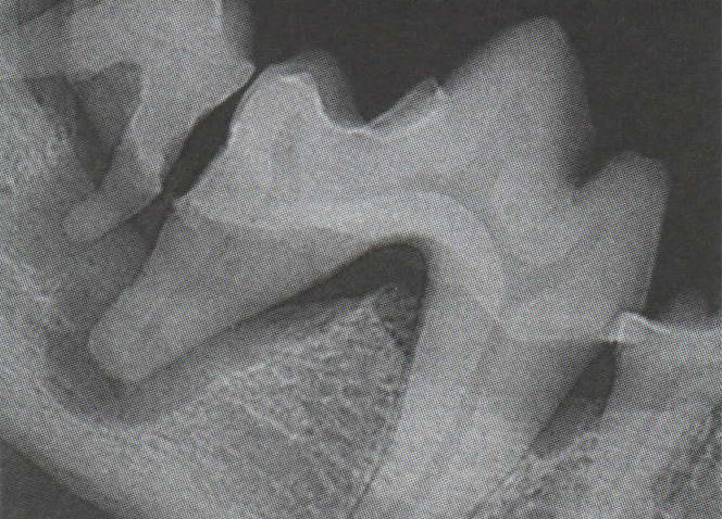 Rentgenogram prvního mandibulárního moláru s pohárkovým defektem v okolí distálního kořene. Mandibula v tomto stupni poškození je vážně poškozena frakturou.