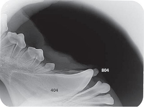 Úplná resorpce kořene a částečná resorpce krčku dočasného zubu 804