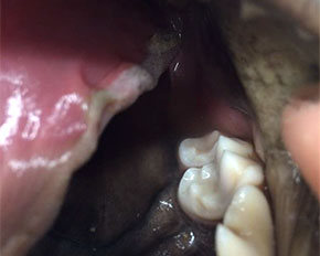 Zubní kaz – po ukončení remodelace