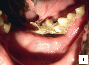 Obr. 1 – Množství hnisu a hlenu, který spolu s rostlinnými zbytky pokrývá dislokovaný první a druhý mandibulární molár, výrazný ústup dásní. Třetí mandibulární molár není pod hlenem a hnisem viditelný.