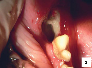 Obr. 2 – Nekrotická kost na dně defektu po extrakci druhého a třetího mandibulárního moláru a distálního kořene prvního mandibulárního moláru.
