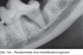 Parodontitida, levý mandibulární segment