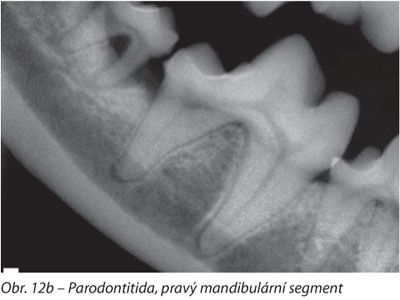 Parodontitida, pravý mandibulární segment