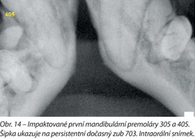 Impaktované první mandibulární premoláry 305 a 405. Šipka ukazuje na persistentní dočasný zub 703. Intraorální snímek.