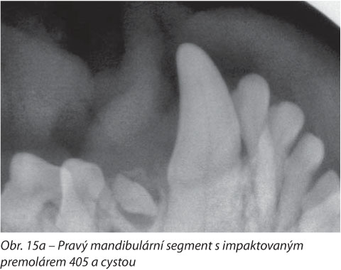 Pravý mandibulární segment s impaktovaným premolárem 405 a cystou