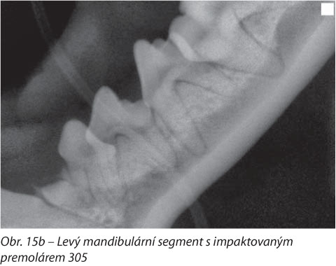 Levý mandibulární segment s impaktovaným premolárem 305
